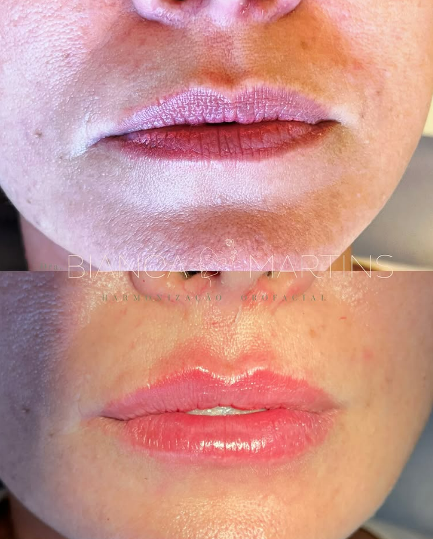 preenchimento labial